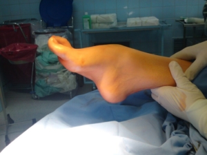 stopa końsko-szpotawa