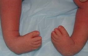 stopa końsko-szpotawa 4